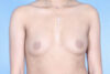 Breast Augmentation case #3363