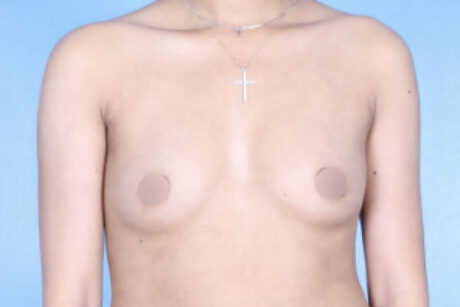 Breast Augmentation case #3363