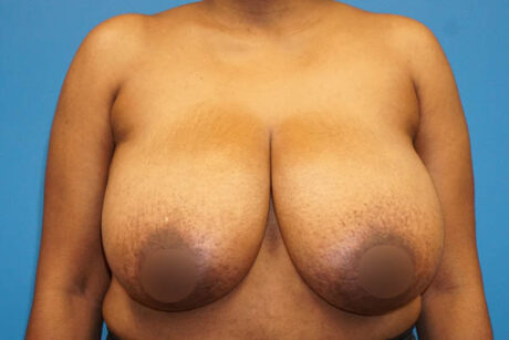 Breast Reduction case #3435