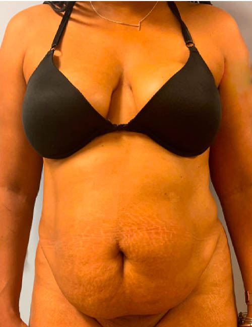 Real patient #1 Tummy Tuck before photo