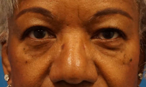 Eyelid Surgery case #3402