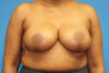 Breast Reduction case #3435