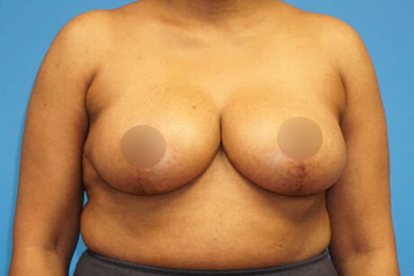 Breast Reduction case #3435