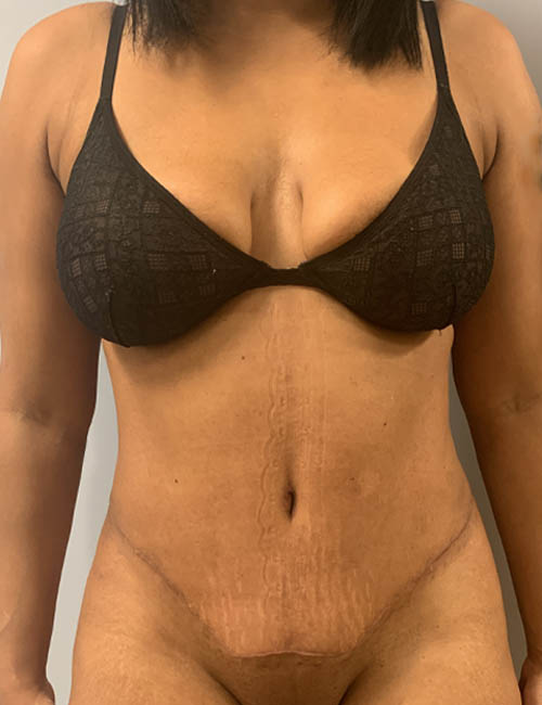 Real patient #1 Tummy Tuck after photo