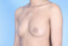 Breast Augmentation case #3363