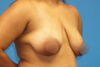 Breast Lift case #3333