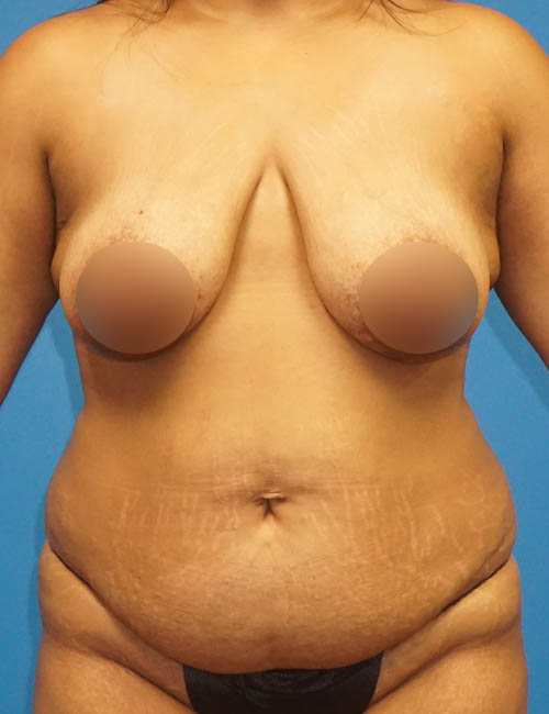 Real patient #2 Tummy Tuck before photo