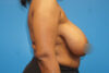 Breast Reduction case #3435