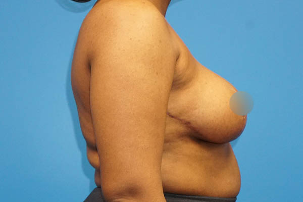 Breast Reduction case #3435