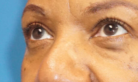 Eyelid Surgery case #3402