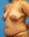 Tummy Tuck case #3304