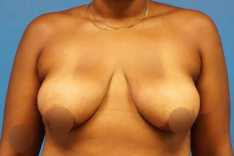 Breast Lift case #3338