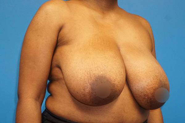 Breast Reduction case #3435