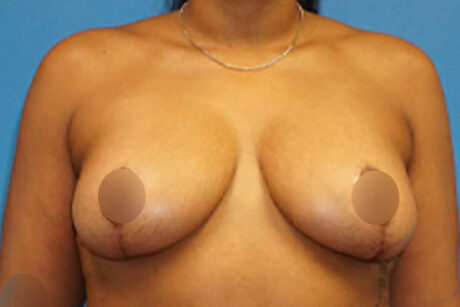 Breast Lift case #3338