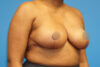 Breast Reduction case #3435