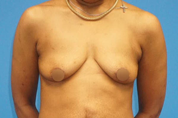 Real patient #1 Breast Augmentation before photo