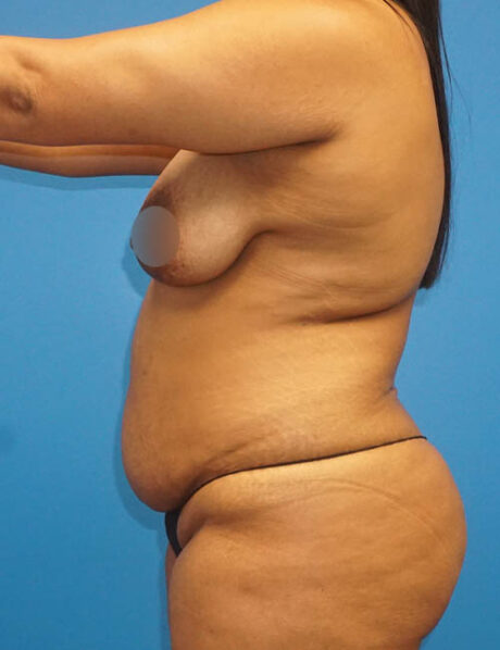 Tummy Tuck case #3304