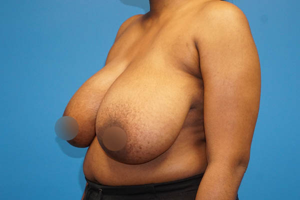 Breast Reduction case #3435