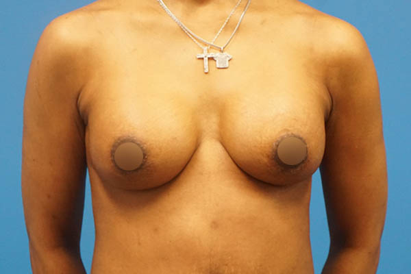 Real patient #1 Breast Augmentation after photo