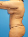 Tummy Tuck case #3304