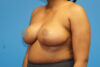 Breast Reduction case #3435