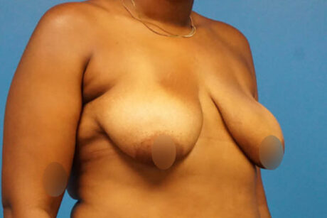 Breast Lift case #3338