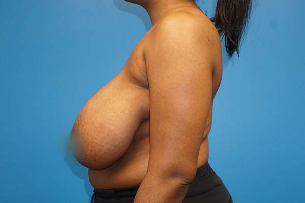 Breast Reduction case #3435