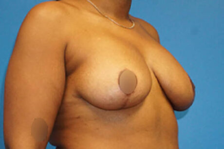 Breast Lift case #3338