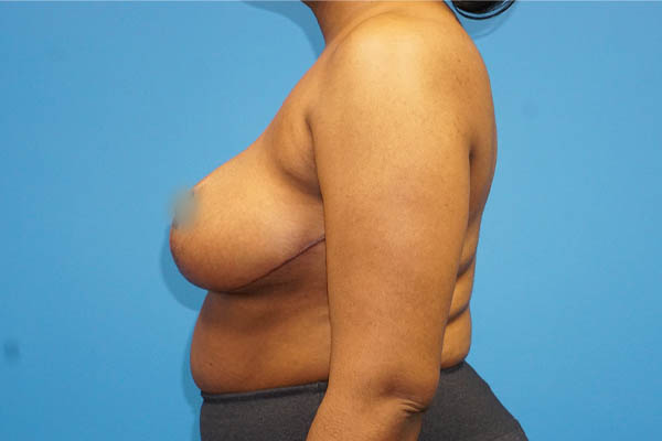 Breast Reduction case #3435