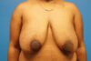 Breast Reduction case #3451