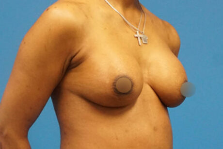 Breast Augmentation case #3370