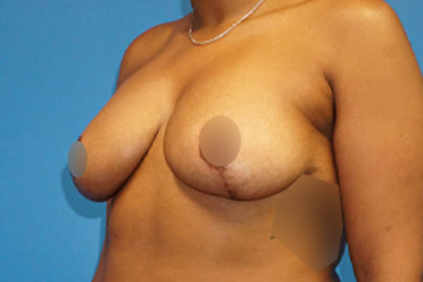 Breast Lift case #3338