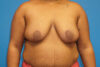 Breast Reduction case #3451