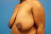 Breast Reduction case #3451