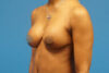 Breast Augmentation case #3370