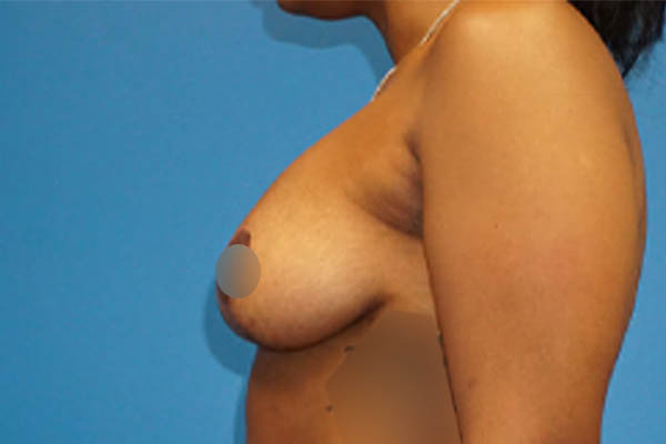 Breast Lift case #3338