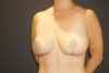 Breast Revision case #3322