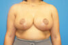 Breast Reduction case #3379