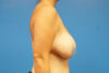 Breast Revision case #3322