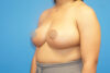 Breast Reduction case #3379