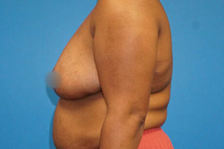 Breast Reduction case #3451