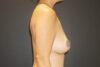 Breast Revision case #3322