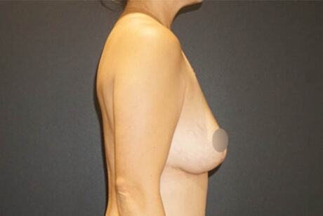 Breast Revision case #3322