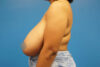 Breast Reduction case #3379