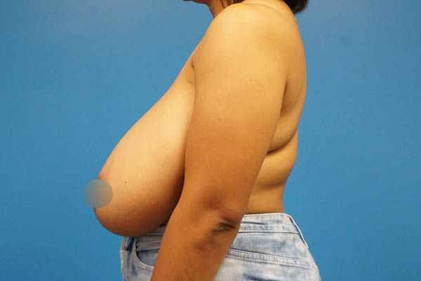 Breast Reduction case #3379