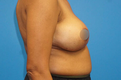 Breast Lift case #3349