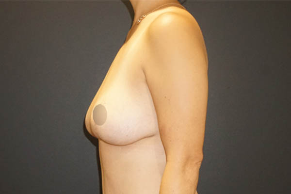 Breast Revision case #3322