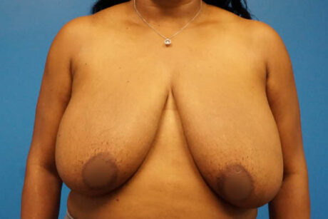 Breast Reduction case #3462