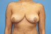 Breast Reduction case #3386