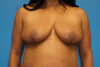 Breast Reduction case #3462